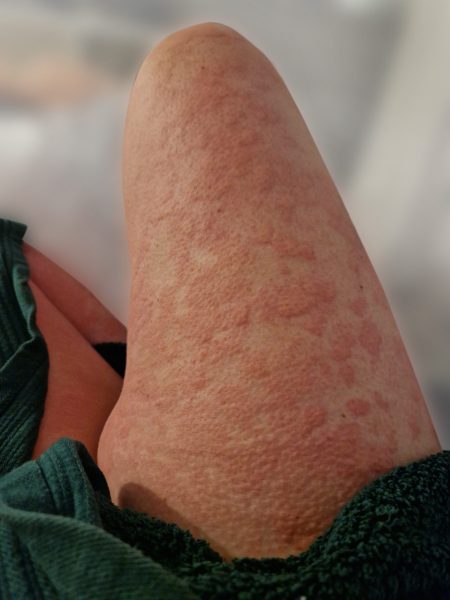 Urticaria rash Copyright © Irish Skin Foundation 2023