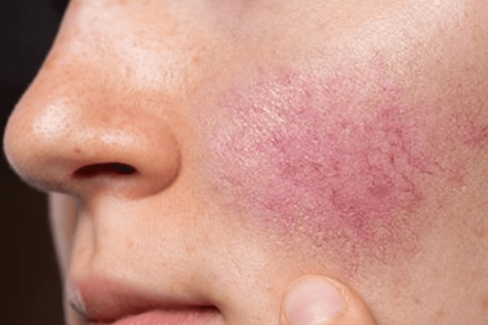 Rosacea aspect ratio 3.2